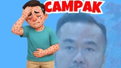 Kewaspadaan Campak di Sidoarjo Meningkat